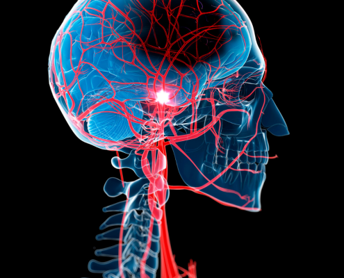 A Fonoaudiologia e o Acidente Vascular Cerebral