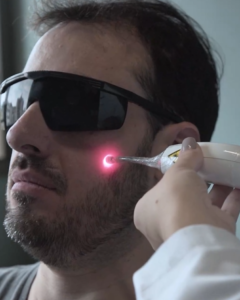 tratamento paralisia facial laserterapia
