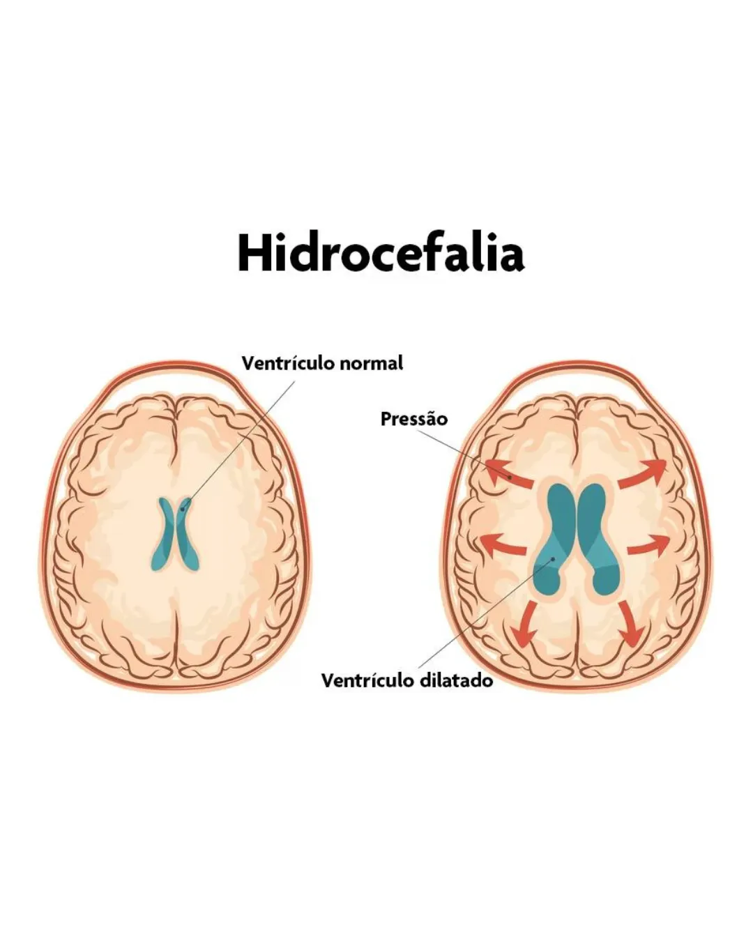 hidrocefaleia (2)_11zon